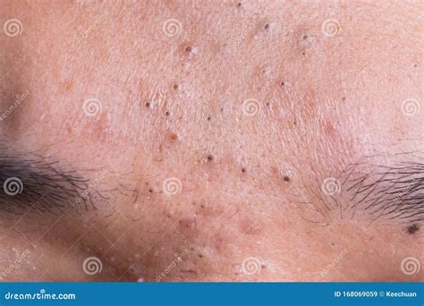 Ugly Pimples Blackheads on Forehead of Teenager Stock Image - Image of ...