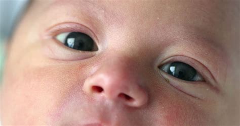 Cataract Eye Newborn at Emily Marsh blog