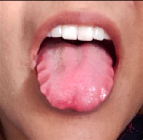 Ridges On Side Of Tongue