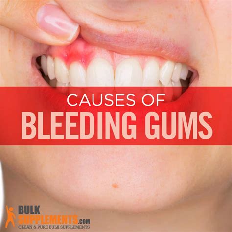 Vitamin C Deficiency Causes Bleeding Gums at Barbara Ridgley blog