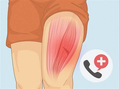 Upper Thigh Leg Pain Causes Femoral Neuropathy: Causes, Risk Factors,