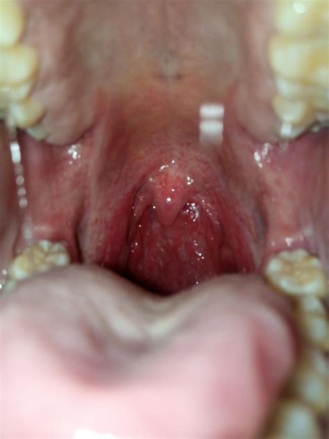 Cobblestone Throat In Child at Carolyn Wilson blog