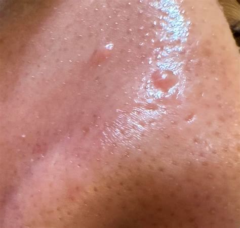 [Acne] Bumps on nose won’t go away. Not sure if CC or milia or ...