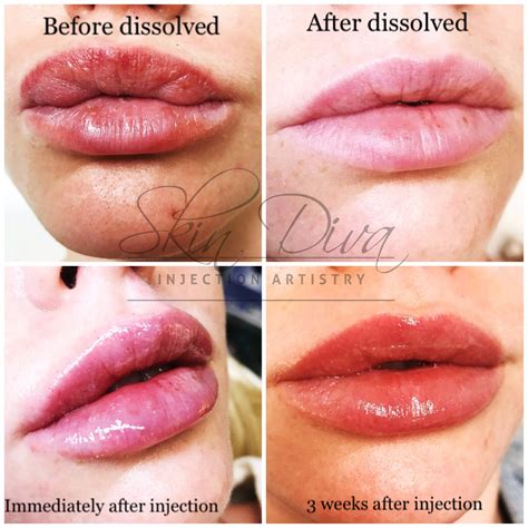 What Makes Lip Fillers Dissolve Faster at Michele Bodden blog