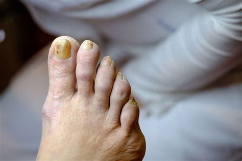 Medical Term For Thick Yellow Toenails at Lucy Gardiner blog