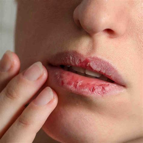 Get Rid of Chapped Lips | Home Remedies