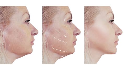 What Helps With Jowls