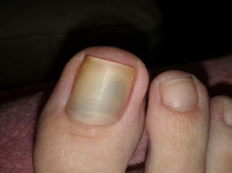Toe Nail Melanoma Treatment at James Jain blog