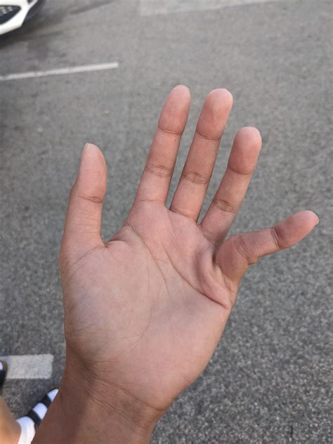 My dislocated pinky finger : r/mildlyinteresting