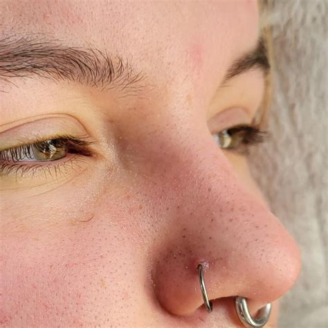 Keloid or Irritation bump? : r/PiercingAdvice