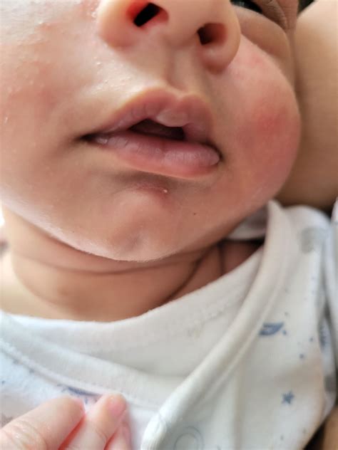 Breastfeeding Baby Has Blister On Lip at Reginald Hopkins blog