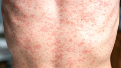 What are the symptoms of measles? And answers about vaccine, more