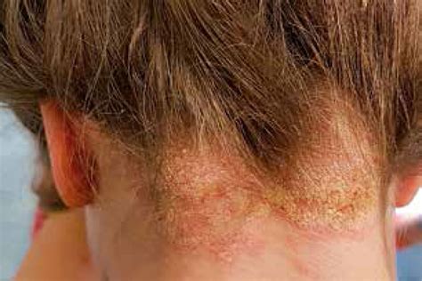 Psoriasis On Back Of Neck