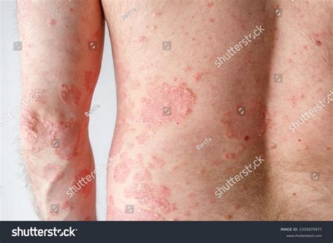 Papules Chronic Psoriasis Vulgaris On Male Stock Photo 2335875977 | Shutterstock