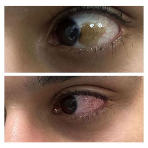 Eye Freckle Treatment: Expert Care at Blue Fin Vision®