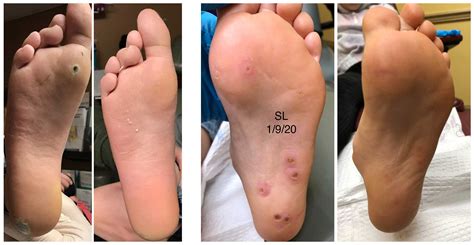 Plantar Wart Removal Surgery Video at Vaughn Josephs blog