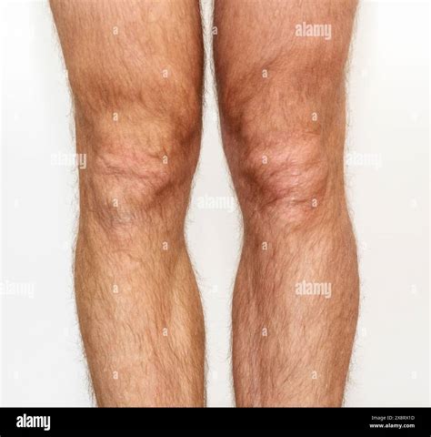 Front view of male knees with Osgood–Schlatter disease, right leg after surgery Stock Photo - Alamy