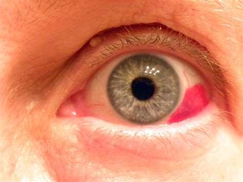 Red Eyeball Causes