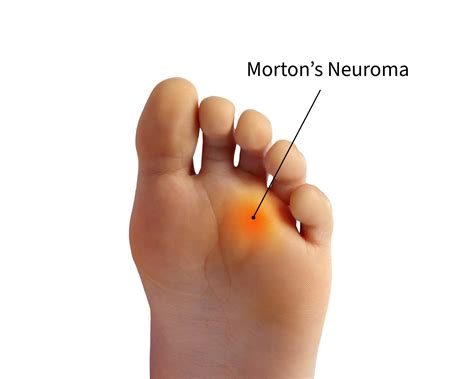 Treatments For Morton's Neuroma - London Foot and Ankle Centre