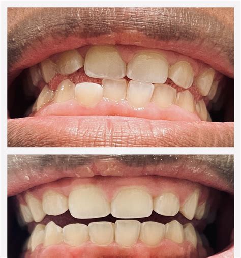 Completed my treatment today! Picture is from two weeks ago but I am ...