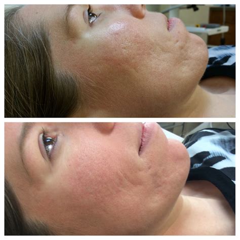 Scar Treatment Laser Before And After at Madeleine Frayne blog