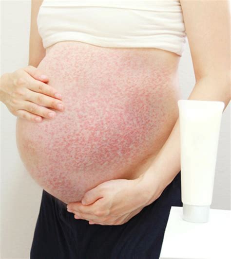 Insect Bites During Pregnancy: Risks, Treatments & Prevention