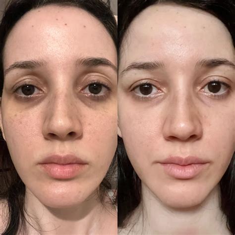 3 months tretinoin 0,05% Results! : r/tretinoin