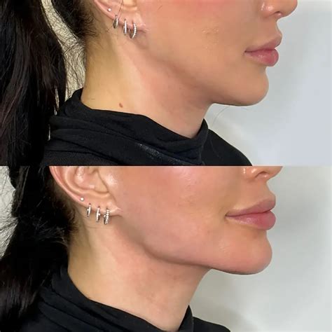 Best Jawline Filler London | Derma Aesthetics London