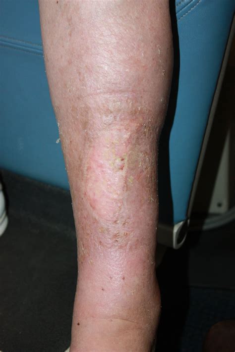 What Is The Medical Definition For Venostasis at Robbin Carpenter blog