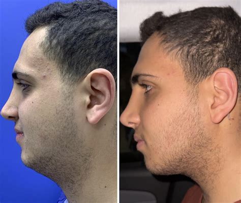 Before and after double chin lipo, 1 week post OP : r/PlasticSurgery