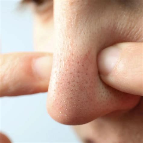 A skin without blackheads: it is possible! - Nidéco