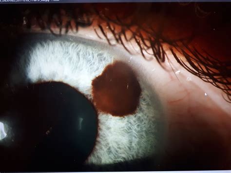I have a 0.58mm nevus in the iris of my left eye : r/eyes