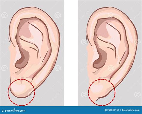 Free Earlobe and Attached Earlobe in Comparison. Stock Illustration ...