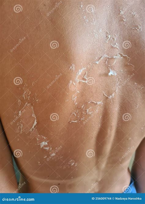 Peeling Skin after Sunburn on Back.Human Skin with Dry Flaky Skin Stock Photo - Image of ...