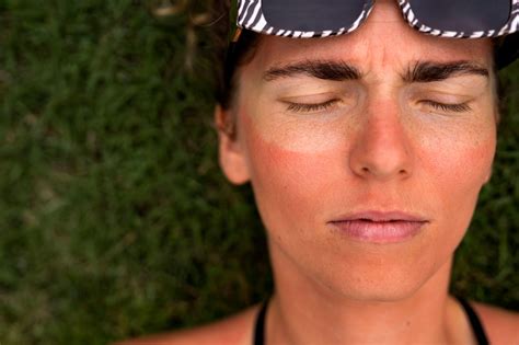 Sunburn: Causes, Symptoms, and Remedies