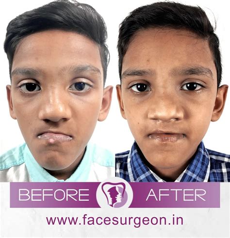 Van der Woude Syndrome - lip pits excision | Facial plastic surgery, Facial surgery, Cleft lip ...