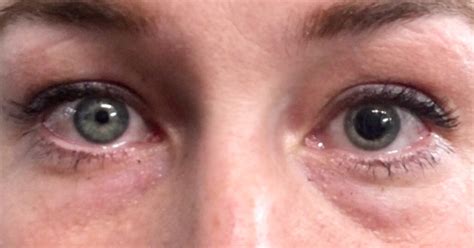 Unilateral Fixed Dilated Pupil 5 Causes Of Dilated Pupils: What Is