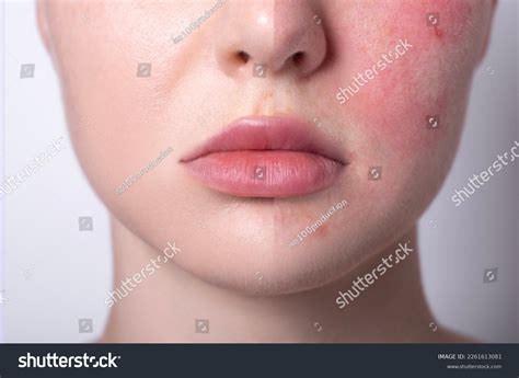679 Allergy Before After Images, Stock Photos & Vectors | Shutterstock