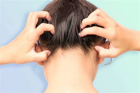Scalp Psoriasis Hair Loss