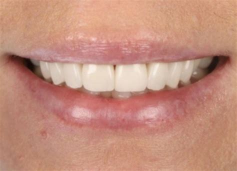 Gum Abscess Popped? Thinking of Popping It Yourself?