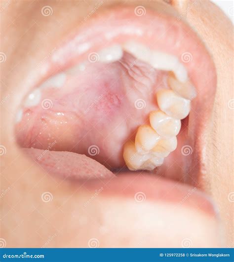 Ampollas En La Boca Infecci?n Foto de archivo - Imagen de ampolla, oral: 125972258