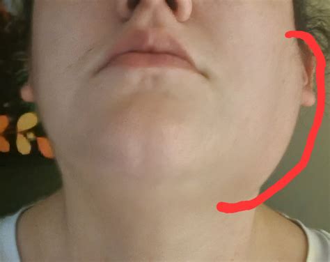 Swollen lymph node for 2 months : r/lymphnodes