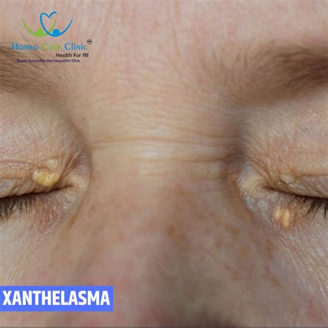 Xanthelasma Causes Symptoms And Treatment Xanthelasma Removal Laser