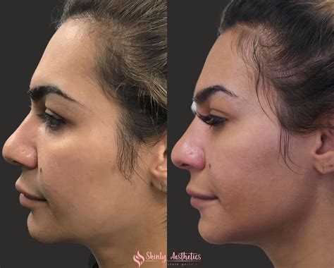 Jawline Fillers - Before & After Results at Skinly