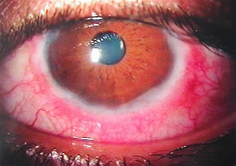 Vernal conjunctivitis, causes, symptoms, diagnosis, treatment & prognosis