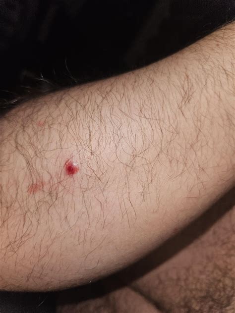 Unusually, blood-filled pimple : r/medical