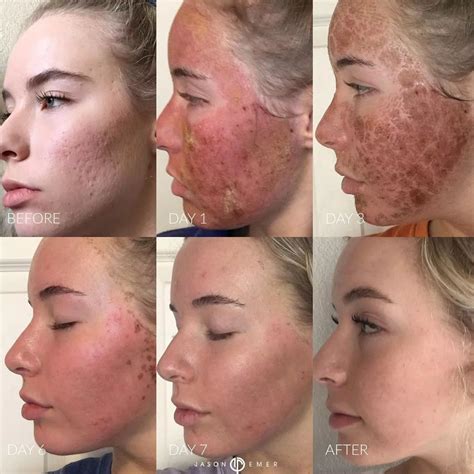 Laser Skin Resurfacing - Cosmetic Dermatologist Dr. Jason Emer