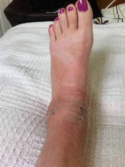 Ankle Trauma Symptoms