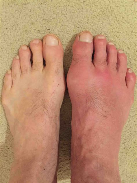 Gout Foot Deformity at Lashay Carlson blog