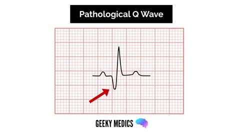 How to Read an ECG | ECG Interpretation | EKG | Geeky Medics
